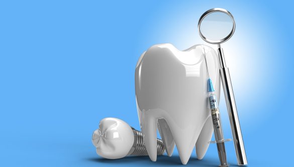 De ce să alegi sistemele de implant dentar performante, în locul celor cu buget redus